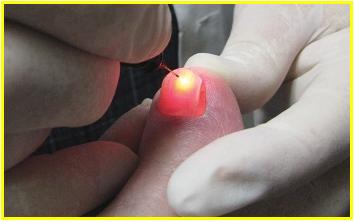 laserterapia